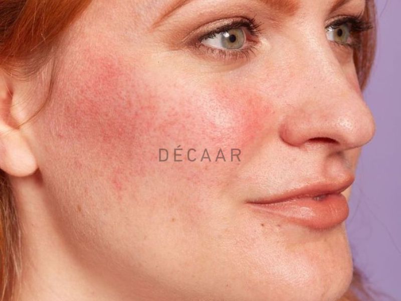 dấu hiệu da bị nhiễm corticoid nhẹ